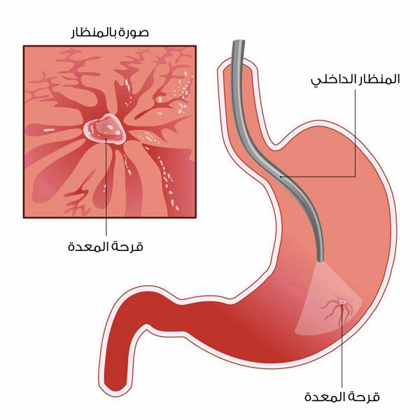 قرحة المعدة وأعراضها وكيفية العلاج منها